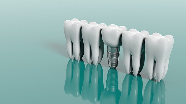 Who Is a Candidate for Dental Implants? - Cynthia A. Mumma DDS PA  Wilmington Delaware
