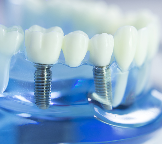 Wilmington Dental Implants